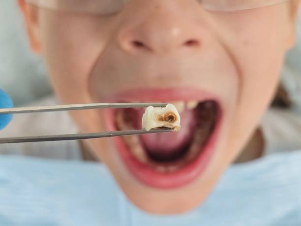 Best Dentist for Tooth Abscess  in Maple Plain, MN